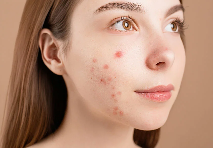 Polikistik Over Sendromu’nda Sivilce ve Tedavisi