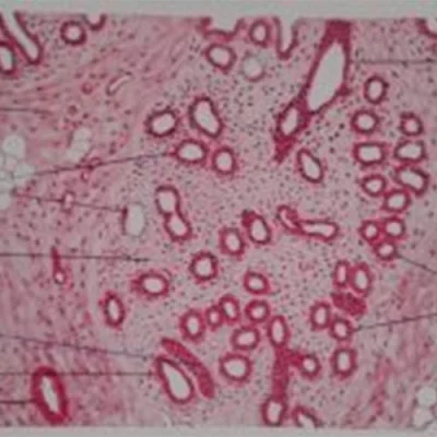 Polikistik Over Sendromu Meme Gelişimi