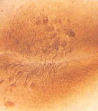 Polikistik Over Sendromu’nda Cilt Renginde Koyulaşma ve Et Benleri