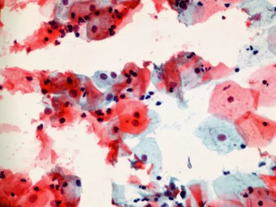 Polikistik Over Sendromu’na En Çok Benzeyen Hastalık Adrenal Hiperplazi