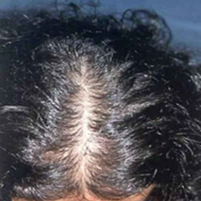 Polikistik Over Sendromu’nda Saç Dökülmesi ve Tedavisi