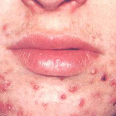 Polikistik Over Sendromu’nda Sivilce ve Tedavisi