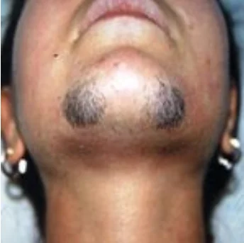 Polikistik Over Sendromu’nda Tüylenme Artışı ve Tedavisi